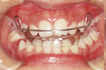 上顎前突（出っ歯）非抜歯・2段階の治療①