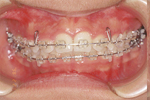 上顎前突（出っ歯）非抜歯・2段階の治療②