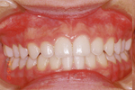 上顎前突（出っ歯）非抜歯・2段階の治療②