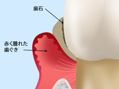 歯ぐきが腫れてきた